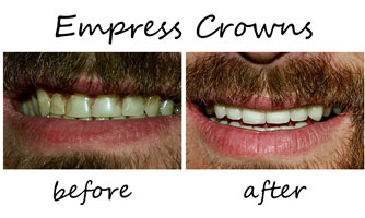 Dental Crowns 3