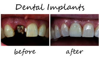 Dental Implants 2